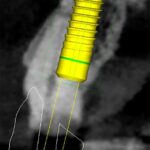 Fig. 2b: The CBCT shows the presence of