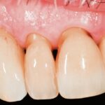 Fig. 2c: Definitive restoration and immediate post-restoration radiograph