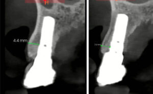 Figs 10a - b: CBCT scan of UR3 and UL3 after 15 years exhibits 3 - 4 mm facial bone at the implant rough surface junction. The bone is maintained coronal to the implant-abutment junction