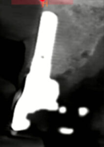 Fig. 10c: CBCT scan of UR1 shows a lack of facial bone on the same TL implant design as used in the canines