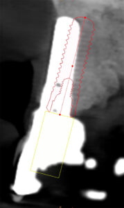Fig. 10d: Demonstrates the facial malposition of UR1 implant. Had this implant been placed in the highlighted schematic position, it is very likely that this implant would have similar facial bone outcome as the canines