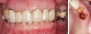 Figs 11a - b: Longstanding conventional metal ceramic crowns. UL2 and UL3 crowns were linked and gross caries was noted under UL3 crown after dismantling of the restoration. UL3 was unrestorable