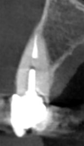 Fig. 11c: CBCT scan shows a Class IIB root position with <1 mm facial bone, if present