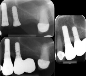 Figs 11k - m: Radiographs confirm a similar response
