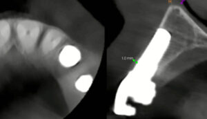Figs 11n - o: Buccal bone thickness <1 mm