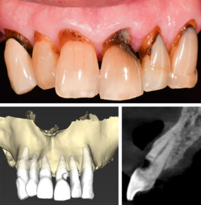 Figs 12a – c: Baseline situation of UL1 with subgingival root caries and generalized gingival recession. CBCT scan showing a class III root position and <1 mm buccal bone thickness with a vertical bone loss up to 50% of the root length
