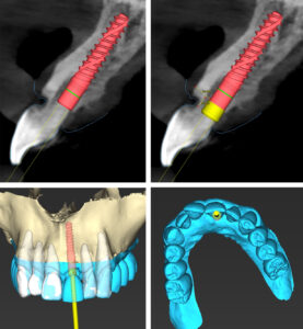 Figs 12d - g: UL1 was virtually extracted. The implant shoulder depth planned 2 mm from the mucosal zenith of UR1. To aid 3D visualization, an abutment of known height helps to visualize the optimal implant position. A screw-retained restoration is planned. Implant osteotomy planned along the palatal wall to maintain >2 mm distance from the buccal bone crest. “S” type (collar height 2.8 mm) was selected to compensate for the vertical buccal bone loss and coronally shift the soft tissue to mitigate the soft tissue deficit