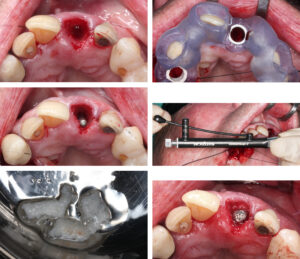 Figs 12h - m: Surgical steps for static computer-assisted implant surgery