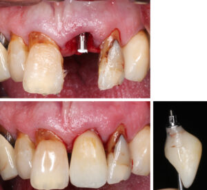 Figs 12n - p: Immediate provisional restoration on titanium base abutment