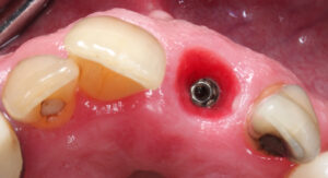 Fig. 12r: Emergence profile optimized for definitive restoration