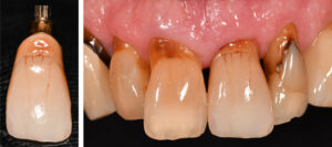 Fig. 12s - t: Definitive restoration achieved excellent pink and white esthetics with reversal of pre-operative apically positioned gingival zenith in UL1