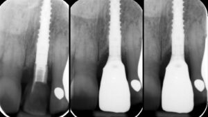 Figs 12u - w: Immediate, 6- and 18-month follow-up radiographs