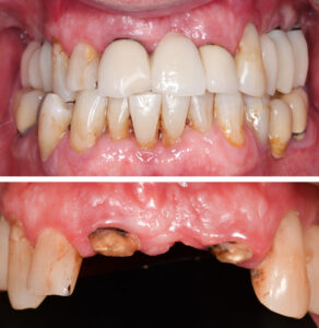 Figs 13a - b: Baseline clinical scenario with a fracture of a 3-unit maxillary anterior bridge extending from UR1 to UL2 with UR1 and UL2 abutments fractured at the cervical margin in a 64-year-old male