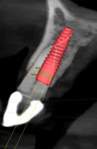 Fig. 13c: Class I root position and >1 mm buccal bone thickness