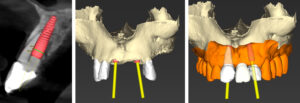 Figs 13d - f: Virtual implant planning. UR1 and UL2 were virtually extracted, and apically tapered tissue level implants (Straumann TLC) were planned for both sites. A screw-retained bridge was planned. Implant osteotomy was planned slightly palatal to the root apices whilst maintaining >2 mm distance from the buccal bone crest. An “NT” type (collar diameter 3.5 mm) was selected to allow for narrower emergence and ideally mimicking recession in adjacent teeth