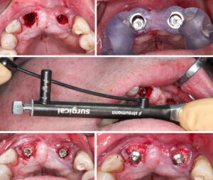 Figs 13g - k: A fully guided placement protocol was implemented. After minimally traumatic extraction of UR1 and UL2, the presence of the buccal wall was confirmed. Implants placed achieving >80 Ncm insertion torque. The horizontal defect grafted up to the implant collar using DBBM-collagen. A 4.5-mm healing abutment placed and additional grafting material placed to support the soft tissues. A cross-suture with 6x0 monofilament nylon placed