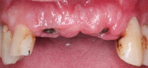 Fig. 13l: One-week healing