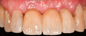 Fig. 13m: Six weeks later, a definitive bridge made in monolithic zirconia on titanium base abutments placed