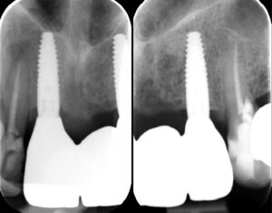 Fig. 13p - q: 1-year radiographs showing stable marginal bone levels at SLA-machine collar junction