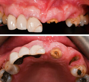 Figs 14a - b: A 73-year-old female with a fractured 3-unit maxillary anterior bridge extending from UL1 to UL3. The abutment teeth (UL1, UL3) had fractured at the gingival level. Another failing bridge, replacing UR1 to UR3, had a ceramic fracture in UR1 and had been repaired with composite resin restoration