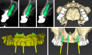 Figs 14c - h: 2 mm distance from the buccal bone crest