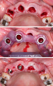 Figs 14i - k: A fully guided placement protocol was followed. The teeth were extracted with a minimally traumatic technique after sectioning the roots. Facial bone wall was confirmed to be present, and all the sockets were thoroughly debrided. Osteotomy preparation was carried out using the fully guided protocol. Implants were placed through the guide, achieving >80 Ncm insertion torque. 3-mm healing abutments were placed, and grafting with DBBM-C (Geistlich BioOss Collagen block) was performed up to the level of healing abutments. No suturing was required. UL1 socket was also grafted with DBBM-C and a cross suture with 6x0 monofilament nylon over the socket opening
