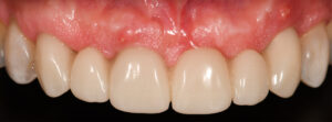 Fig. 14l: Four weeks after healing, a resin provisional bridge was fitted to commence soft tissue conditioning
