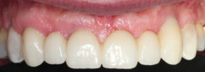 Fig. 14m: The definitive bridge was made in monolithic zirconia on titanium base abutments. Excellent pink esthetics re-created with TL design implants without any hint of grayish hue from the underlying implant collar. The mucosal zenith in UL3 was more apical than desired. This prosthetic error can be attributed to the overcontoured emergence of UL3. It was accepted, assuming that the mucosa might migrate coronally in the fullness of time