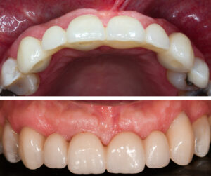 Figs 14n - o: Follow-up after one year shows a well-maintained alveolar convexity around the implants, indicating stability of the peri-implant hard and soft tissues, although no supplemental soft tissue grafting was carried out. However, the UL3 mucosal zenith remained more apical than its contralateral canine