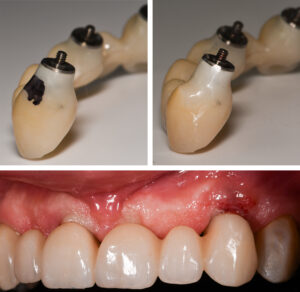 Figs 14p - r: The black highlighted area illustrates the convex overcontoured transmucosal emergence that pushed the mucosa apically. The contour was reduced chairside to a concave shape, and the bridge returned to the patient