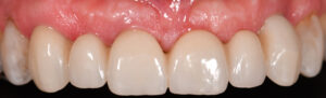Fig. 14s: Four weeks later, the mucosal zenith in UL3 had migrated coronally, allowing for correction of the zenith mismatch between UR3 and UL3. This allowed the soft tissue to “relax” and migrate coronally to correct the deficit and level the zenith with UR3