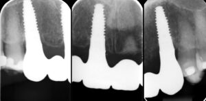 Figs 14t - v: Radiographs after 2 years show stability of marginal bone levels
