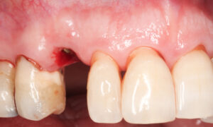 Fig. 2a: UR3 had fractured subgingivally in an otherwise heavily restored dentition with generalized gingival recession and cervical restorations in UR4