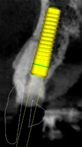 Fig. 2b: The CBCT shows the presence of <1 mm facial bone thickness and a Class IV root position