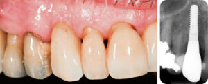 Fig. 2c: Definitive restoration and immediate post-restoration radiograph