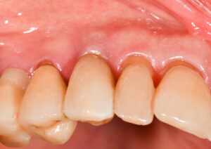 Fig. 2e: Maintenance of alveolar convexity after 4 years in function