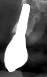 Fig. 2f: CBCT taken after 4 years shows bone coronal to the rough surface