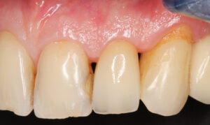 Fig. 3a: Pre-operative view of UL2 fractured at the cervical third