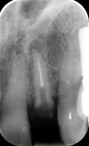 Fig. 3b: Intra-oral peri-apical radiograph of fractured UL2