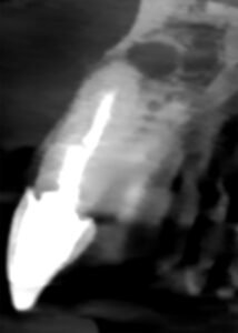 Fig. 3c: The CBCT shows the presence of <1 mm facial bone thickness and a Class IIB root position. A chronic peri-apical lesion is present