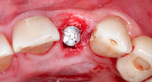 Fig. 3d: Immediate placement of TL implant and DBBM-C placed in the gap facially between the implant and the socket wall