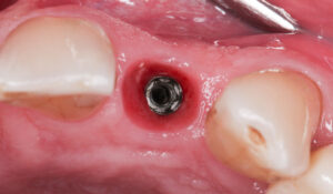 Fig. 3e: Collapse of alveolar convexity noted during the provisionalization stage prior to fit of the definitive crown