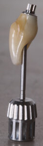 Fig. 3f: Optimal concave sub-mucosal contour of the definitive crown