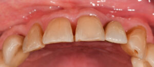 Fig. 3g: Occlusal view showing loss of alveolar contour in UL2 compared to UR2