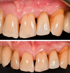 Fig. 3g: Occlusal view showing loss of alveolar contour in UL2 compared to UR2