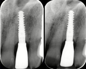 Figs 3j - k: Marginal bone levels after 1 and 2 years