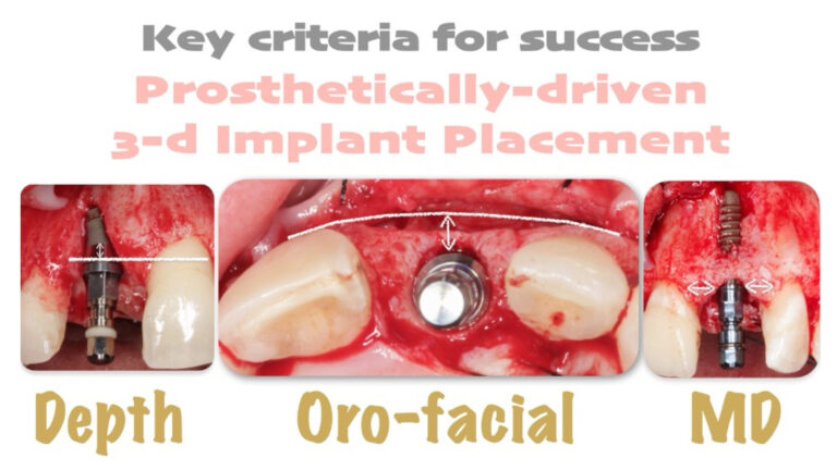 Fig. 4: Ideal 3-dimensional implant position; TL implant should be placed 2 mm apically to the proposed mucosal zenith, >2 mm palatal to adjacent teeth, and >1.5 mm from adjacent teeth