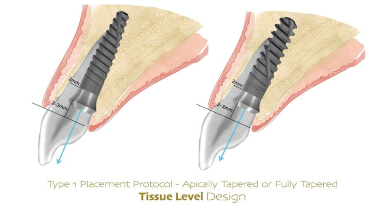 Fig. 5: For immediate placement in the extraction socket, >2 mm horizontal gap should be maintained between the implant and the inner socket wall at the rough surface-machine collar junction
