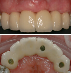 Figs 7a - b: Definitive metal ceramic bridge delivered after two months of healing (treated in 2009)