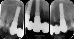 Figs 8a - c: Baseline radiographs 4 weeks after restoration